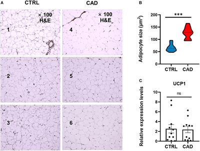 Exploring the Role of Epicardial Adipose Tissue in Coronary Artery Disease From the Difference of Gene Expression